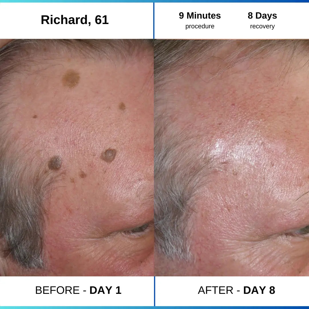 OcuraLife before and after result 5
